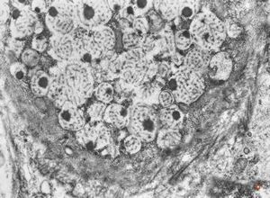 F,31y. | ovary - mucinous carcinoma